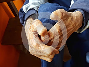 Closeup hands of asian old man suffering from leprosy, Thailand.