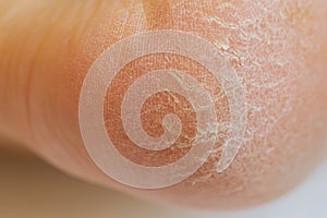 Horny skin on a heel