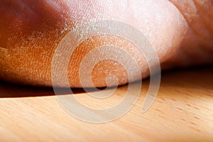 Closeup image of a heel on the foot with a white callus