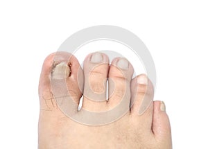 Closeup ingrown nail at the big toe of a man isolated on white background with clipping path