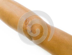 Closeup keloid scar on elbow of Asian man skin after motorcycle accident on white background