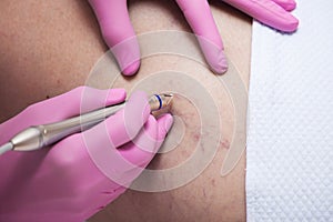 Closeup of laser capillary removel procedure in medical clinic photo