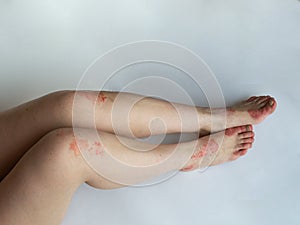 Closeup of the legs of a woman suffering from chronic psoriasis on a white background. Closeup of rash and scaling on the patient