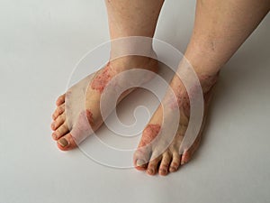 Closeup of the legs of a woman suffering from chronic psoriasis on a white background. Closeup of rash and scaling on the patient