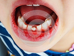 Closeup of lose tooth in a girls mouth