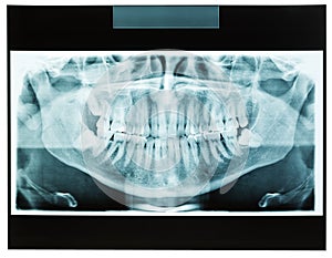 Closeup of man xray jaw for dental teeth doctor photo