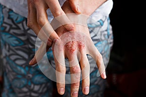 Closeup men itching and scratching by hand. Psoriasis or eczema on the hand. Atopic allergy skin with red spots