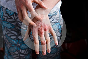 Closeup men itching and scratching by hand. Psoriasis or eczema on the hand. Atopic allergy skin with red spots