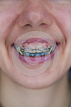 Closeup metal brackets on teeth. Smile with braces.