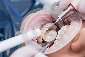 Closeup of modern professional teeth cleaning in dentistry with specialized equipment.
