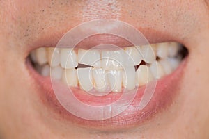 Closeup mouth dental problem. Teeth Injuries or Teeth Breaking in Male.