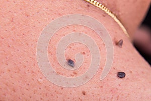 Closeup of multiple moles on shoulder of Asian man