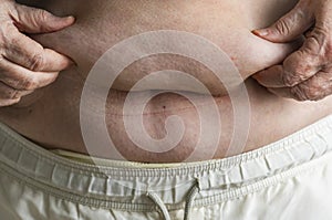 Closeup of obese elderly woman medical concept