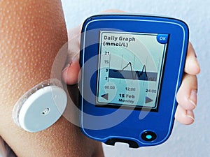Closeup od device for continuously glucose monitoring in  blood â€“ CGM