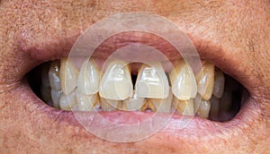 Closeup old woman teeth problems with gums or tartar for healthy