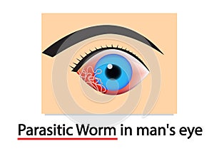 Closeup Parasitic Worms in human`s eye, vector art