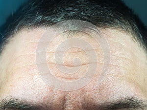 Closeup photo of a male forehead with deep wrinkles and pores