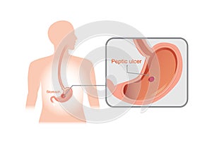 Closeup picture of peptic ulcer