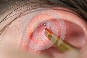 A closeup portrait of an acupuncturist placing an acupressure metal ball sticker on the inside of the ear in the auricle in order