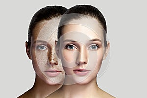 Closeup portrait of beautiful brunette woman with and without freckles on face. healing and removing freckles medical concept. photo