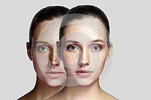 Closeup before and after portrait of beautiful brunette woman after laser treatment removing freckles on face looking at camera.