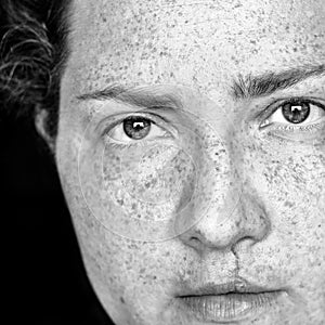 Closeup Portrait of Caucasian Woman with Freckles and Cleft Lip Looking Directly at Camera. Image is in Black and White photo