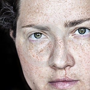 Closeup Portrait of Caucasian Woman with Freckles and Cleft Lip Looking Directly at Camera. photo
