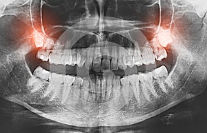 Closeup of x-ray image growing wisdom teeth pain concept.