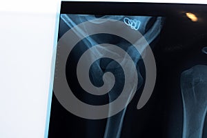 Closeup x-ray of shoulder on gray background