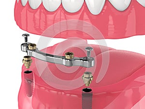 3d render of bar retained removable overdenture installation supported by two implants