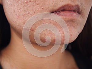 Closeup scar acne photo