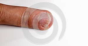 Closeup shot of a finger with Psoriatic onychodystrophy or psoriatic nails on a white background