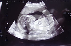 Closeup shot of an obstetric ultrasonography photo
