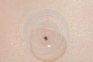 Closeup shot of vaseline to remove ticks from the skin