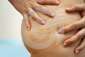 Closeup shot woman having stretch marks on thighs