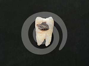 Closeup single bad tooth with caries big hole on black background. Unhealthy teeth photo