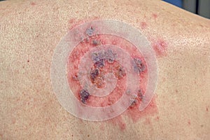 Closeup of skin blisters caused by Shingles