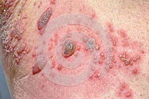 Closeup of skin blisters caused by Shingles photo