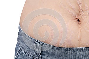 Closeup stretchmarks on woman belly photo