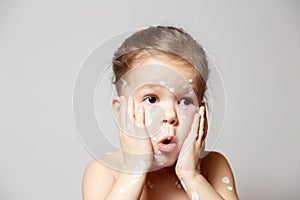 Closeup surprized cute little girl with varicella virus or chickenpox bubble rash, conjunctivitis, sore eyes, red spots covered