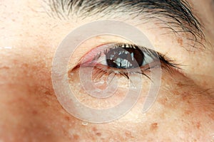 Closeup Swollen eyes or Blepharitis eyes of Asian man. Medicine and healthcare concept photo