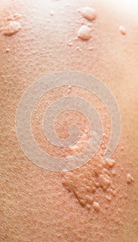 Closeup on symptoms of itchy urticaria photo
