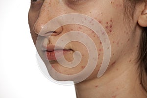 Closeup of teenage girl with problematic skin