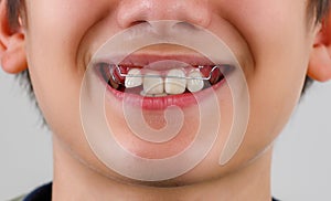closeup teenager boy mouth with diastema overbite teeth missing gap wearing orthodontic appliance treatment.