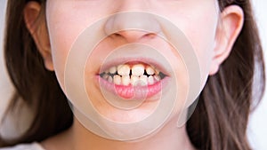 closeup teeth for children dentist and maxillofacial surgeon. clenched teeth photo