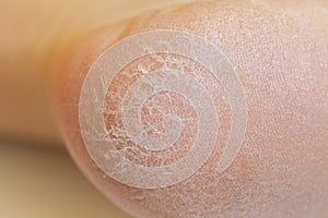 Horny skin on a heel