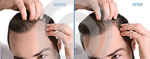 Closeup view of man before and after hair loss treatment on white background, collage. Banner design