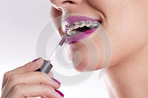 Closeup of woman with braces applying lip gloss