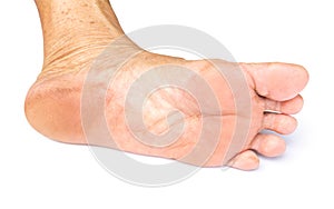 Closeup woman cracked feet and heels on white background with cl