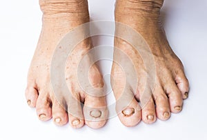 Closeup woman cracked feet and heels on white background, health